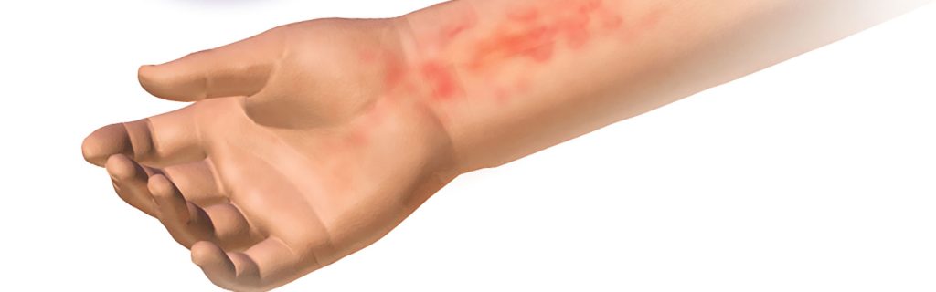 teens and food allergies