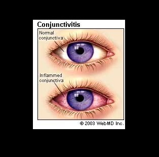Conjunctivitis: What Is Pink Eye? - American Academy of Ophthalmology